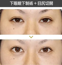 下眼瞼下制法と目尻切開による目の整形例(新宿ラクル美容外科クリニックHPより引用)