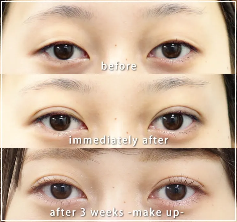 二重埋没法による目の整形例（共立美容外科HPより引用）