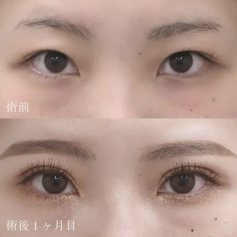 二重切開法による目の整形例（水の森美容クリニックHPより引用）