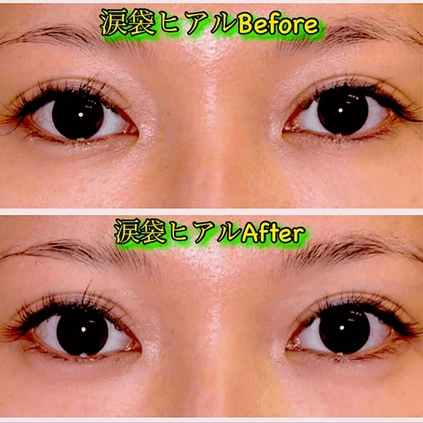 ヒアルロン酸注射による涙袋の整形例(銀座フェイスクリニックHPより引用)の画像