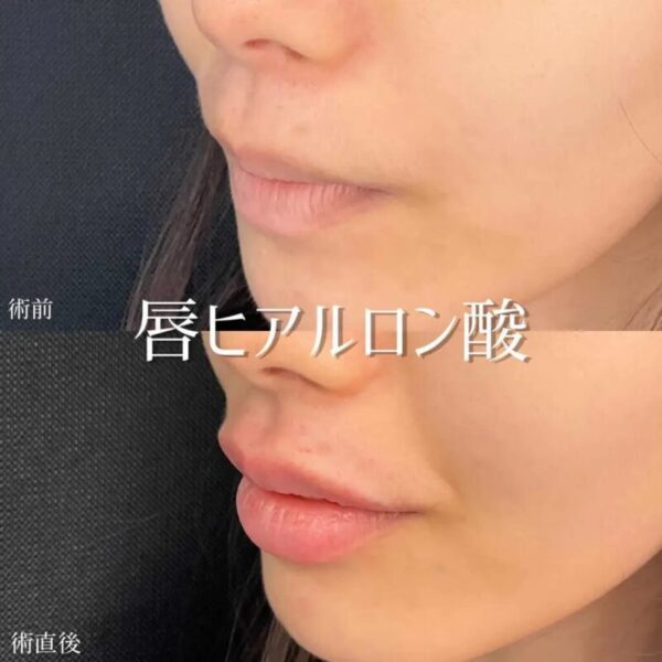ヒアルロン酸注射による唇の整形例（東京シンデレラ美容外科HPより引用）の画像