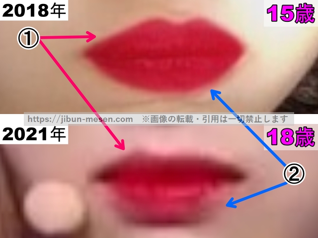 LIMELIGHTみゆの唇の整形検証2018年〜2021年（拡大）の画像
