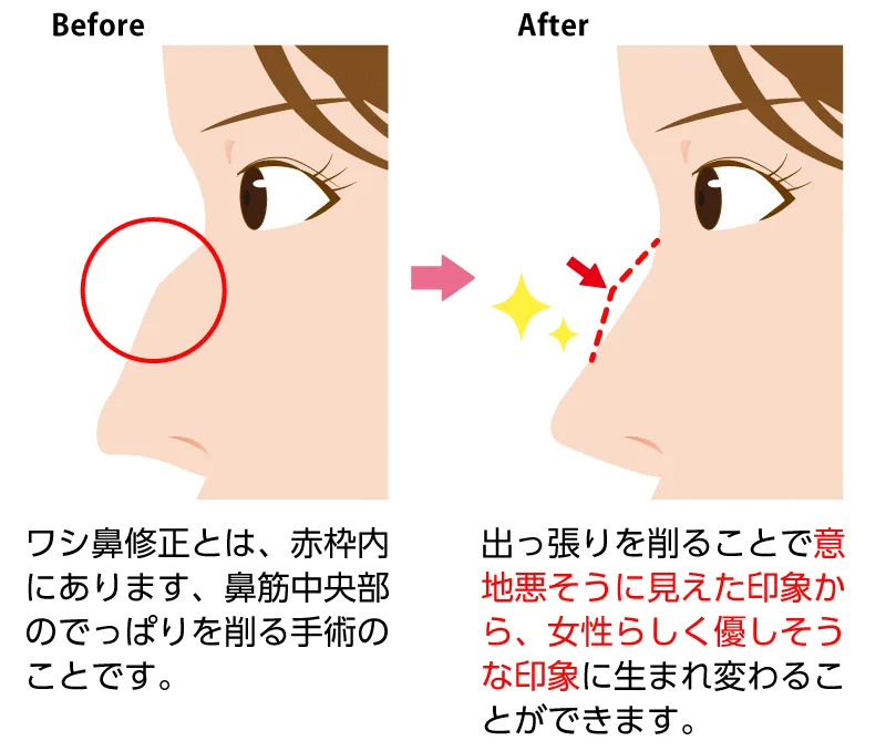 わし鼻修正の例(東京中央美容外科HPより引用)