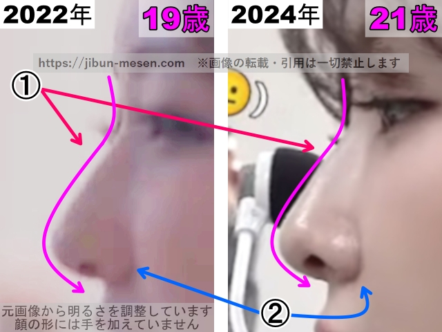LIMELIGHTみゆの鼻の整形検証2022年〜2024年（拡大）の画像