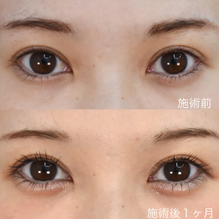 涙袋へのヒアルロン酸注射による目の整形例（ウェンデルクリニックHPより引用）