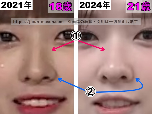 LIMELIGHTみゆの鼻の整形検証2021年〜2024年（拡大）の画像