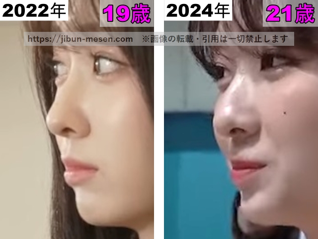 LIMELIGHTみゆの唇の整形検証2022年〜2024年（横顔）の画像