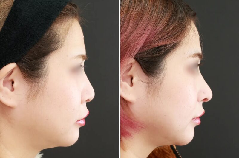 小鼻縮小術による鼻の整形例（TAクリニックグループHPより引用）の画像