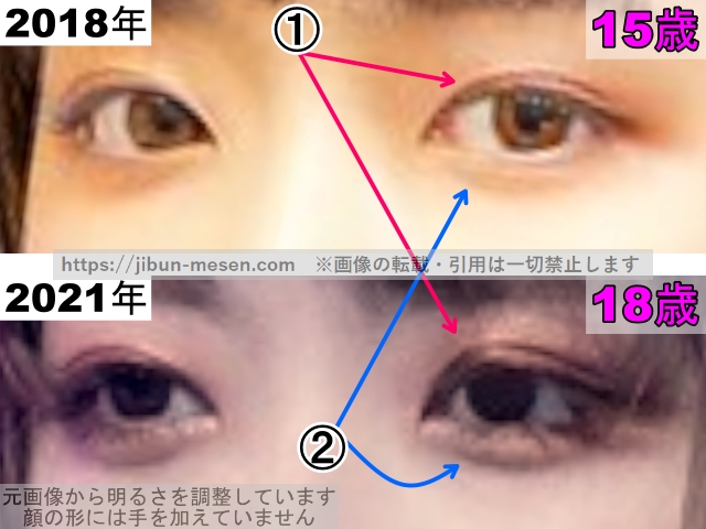 LIMELIGHTみゆの目の整形検証2018年〜2021年(拡大)の画像