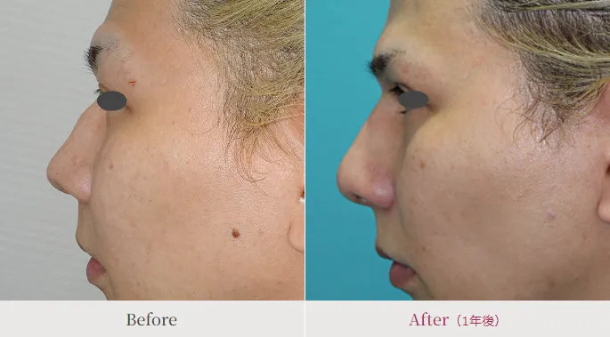 鼻プロテーゼによる鼻の整形例(高須クリニックHPより引用)