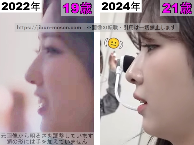 LIMELIGHTみゆの鼻の整形検証2022年〜2024年の画像