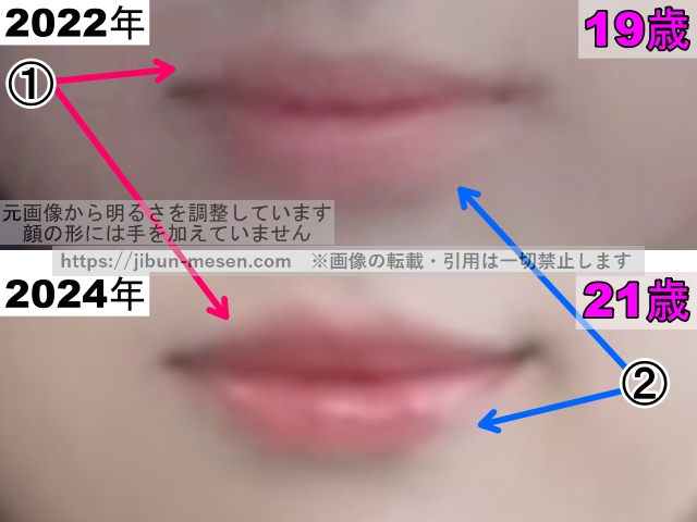 LIMELIGHTみゆの唇の整形検証2022年〜2024年（拡大）の画像