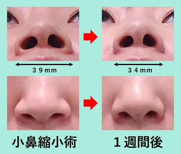 小鼻縮小術による鼻の整形例(WOMクリニック銀座HPより引用)