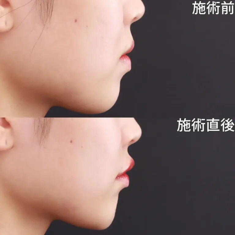 ヒアルロン酸注射による唇の整形例（TAクリニックグループHPより引用）