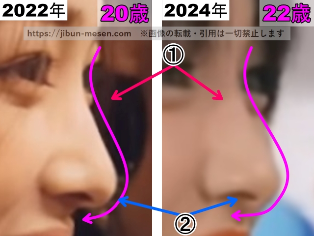 XGジュリンの鼻の整形検証2022年〜2024年（横顔・拡大）の画像