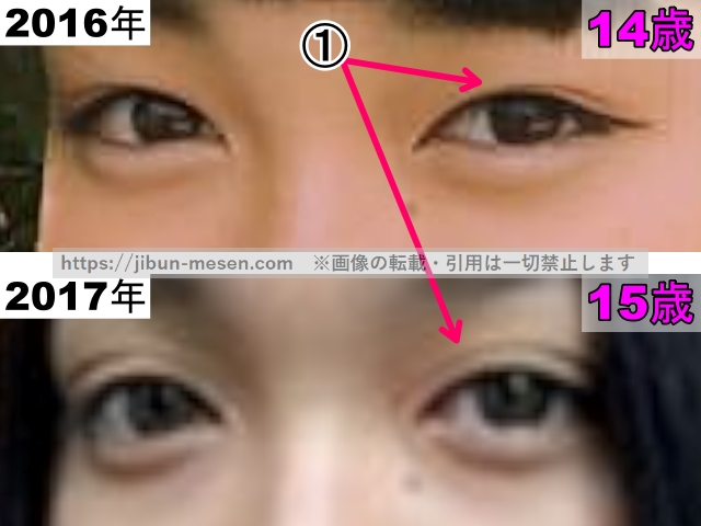 XGジュリンの目の整形検証2016年〜2017年（拡大）の画像