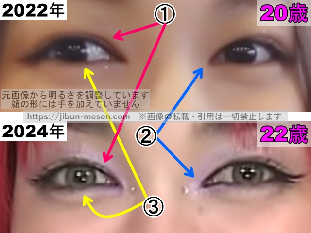 XGジュリンの目の整形検証2022年〜2024年（拡大）の画像