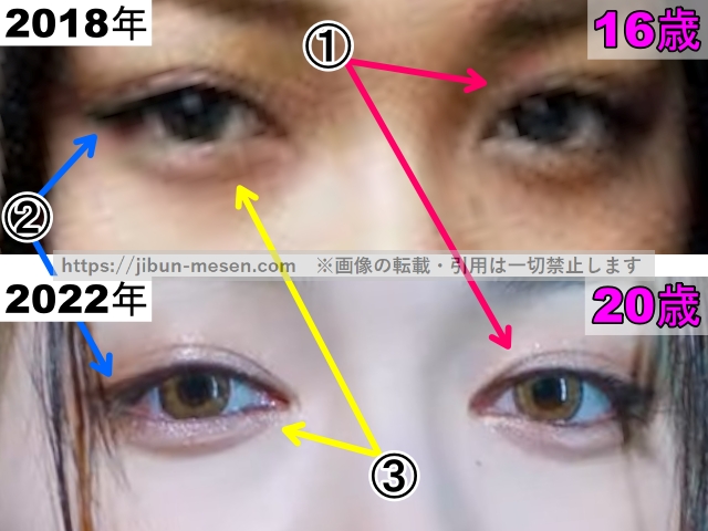 XGジュリンの目の整形検証2018年〜2022年（拡大）の画像