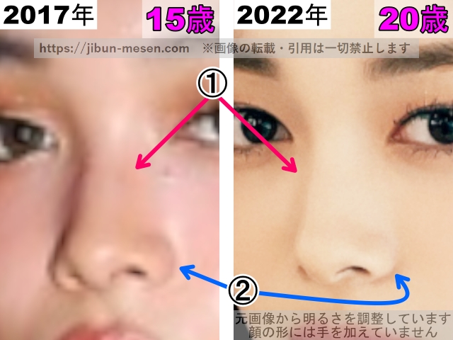 XGジュリンの鼻の整形検証2017年〜2022年（拡大）の画像
