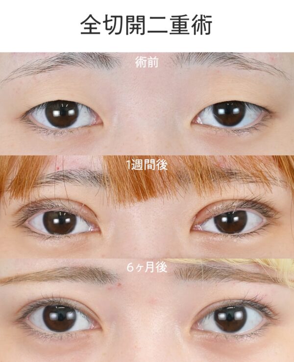 二重切開法による目の整形例（湘南美容クリニックHPより引用）の画像