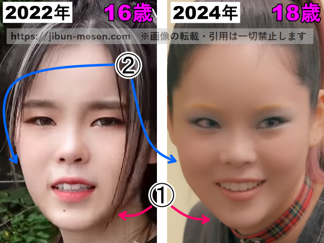 XGココナの頬・輪郭の整形検証2022年〜2024年の画像