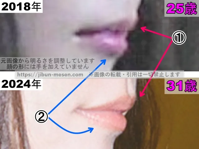 有村架純の唇の整形検証2018年〜2024年（横顔・拡大）