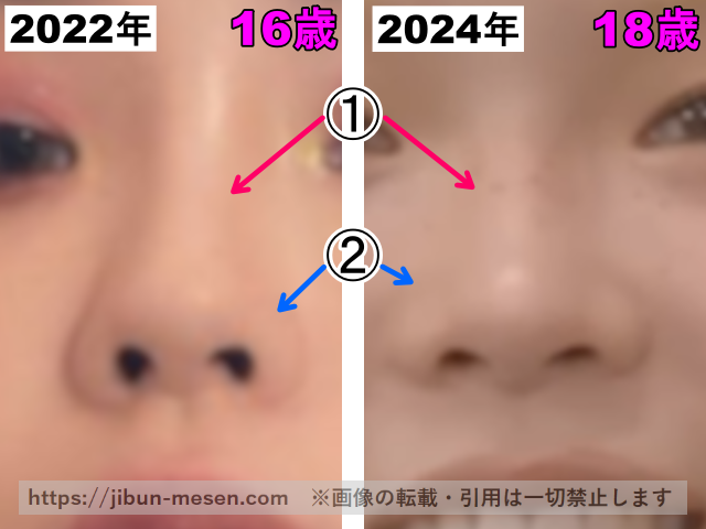 XGココナの鼻の整形検証2022年〜2024年（拡大）の画像
