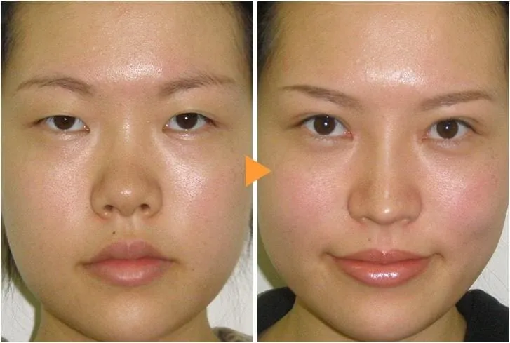 鼻中隔延長による鼻の整形例（銀座みゆき通り美容外科大阪院HPより引用）