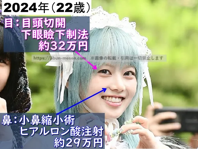 XGヒナタが整形した箇所とその費用