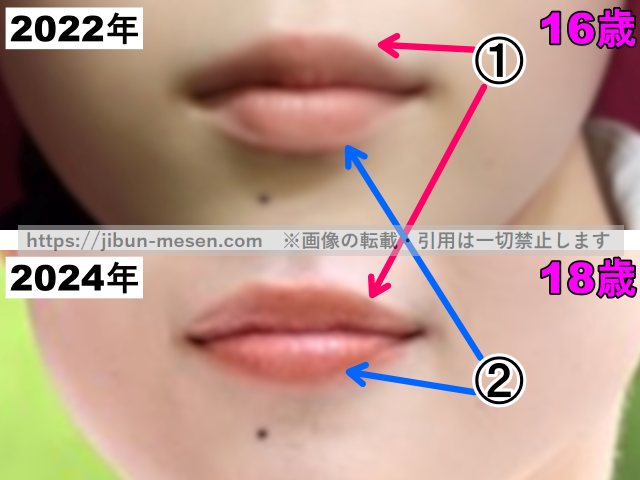 XGココナの口の整形検証2022年〜2024年（拡大）の画像