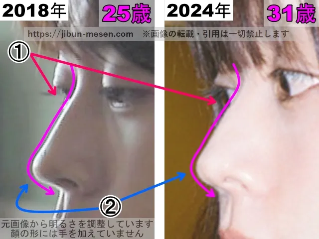 有村架純の鼻の整形検証2018年〜2024年（横顔・拡大）