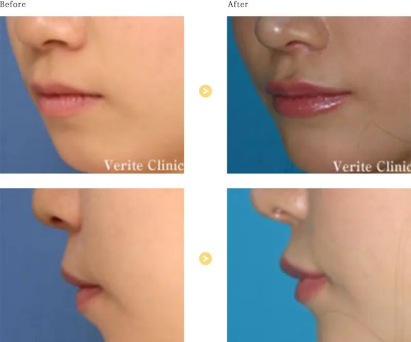 口唇拡大術による唇の症例（ヴェリテクリニックHPより引用）