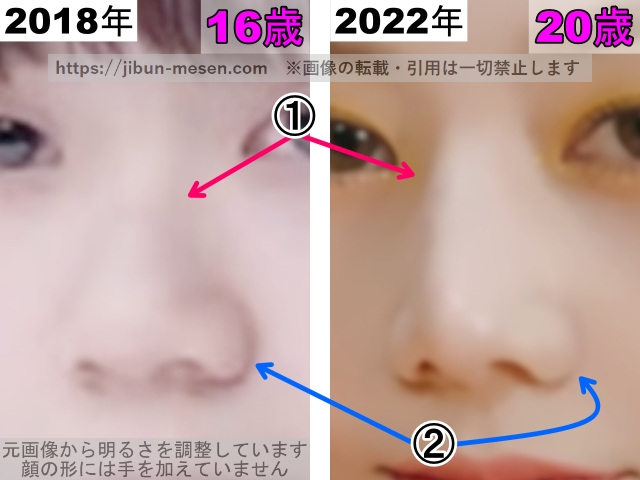 XGヒナタの鼻の整形検証2018年〜2022年（拡大）の画像