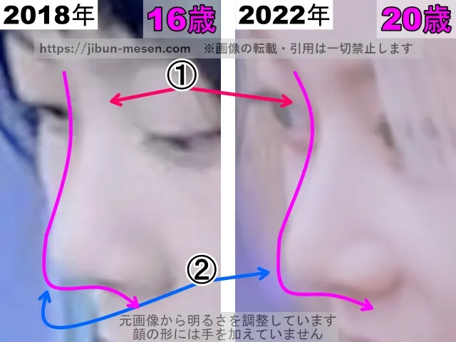 XGヒナタの鼻の整形検証2018年〜2022年（横顔・拡大）