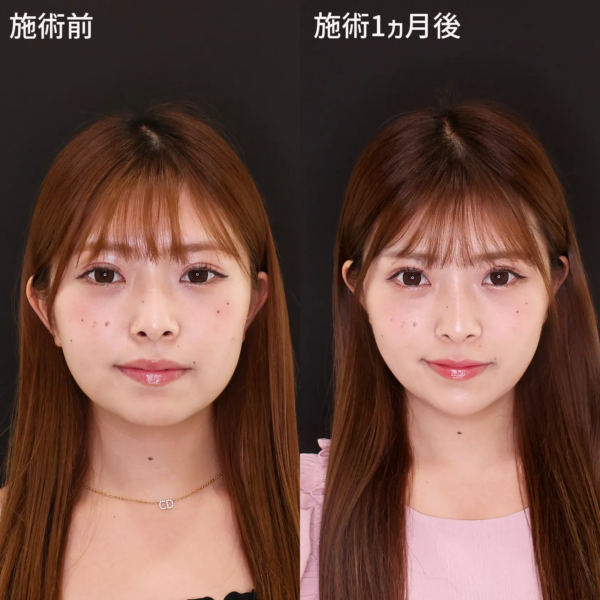 小顔複合施術による整形例（TAクリニックHPより引用）の画像