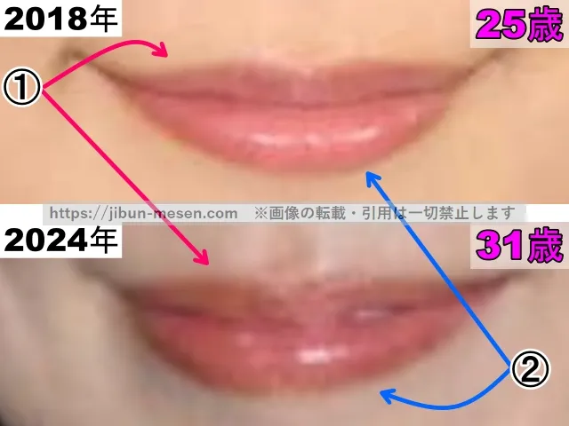 有村架純の唇の整形検証2018年〜2024年（拡大）