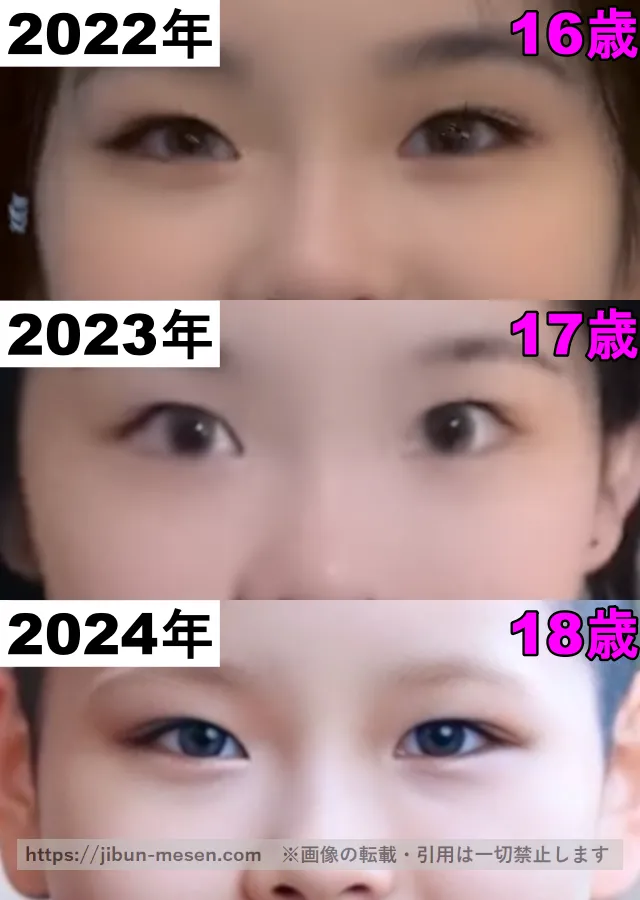 XGココナの目頭の整形検証2022年〜2024年