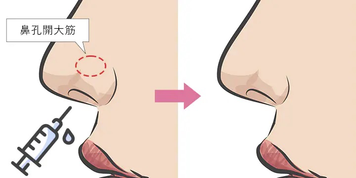 小鼻ボトックス注射の整形イメージ（湘南美容クリニックより引用）の画像