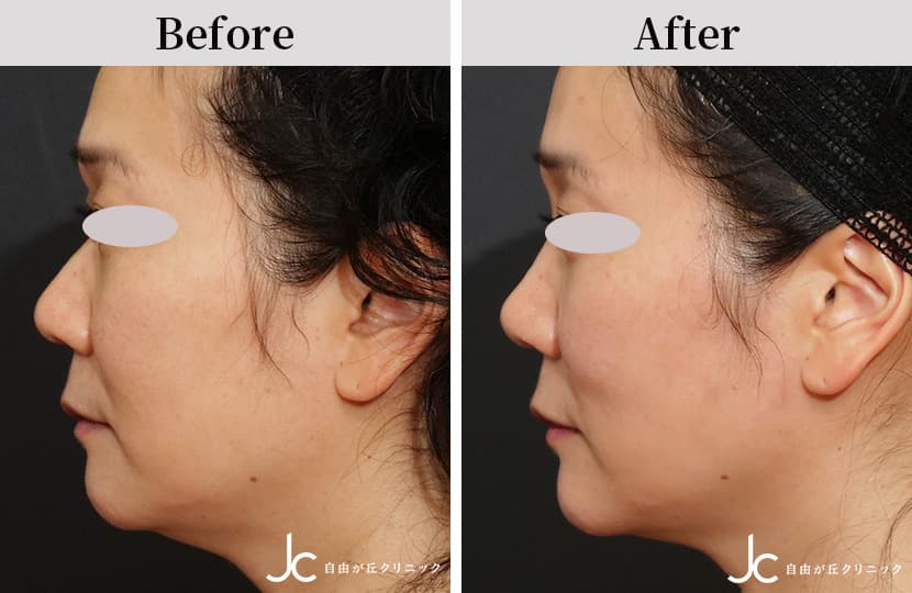 ヒアルロン酸注射による頬の整形例（自由が丘クリニックHPより引用）_2の画像