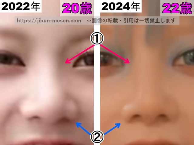 XGヒナタの鼻の整形検証2022年〜2024年（拡大）の画像