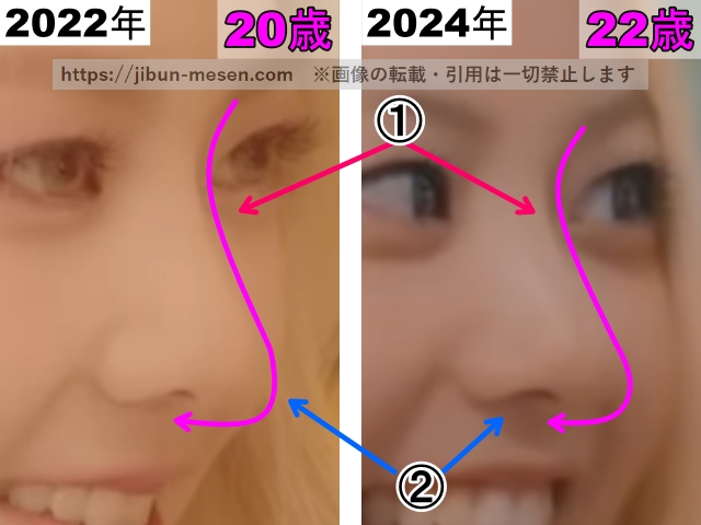 XGヒナタの鼻の整形検証2022年〜2024年（横顔・拡大）の画像