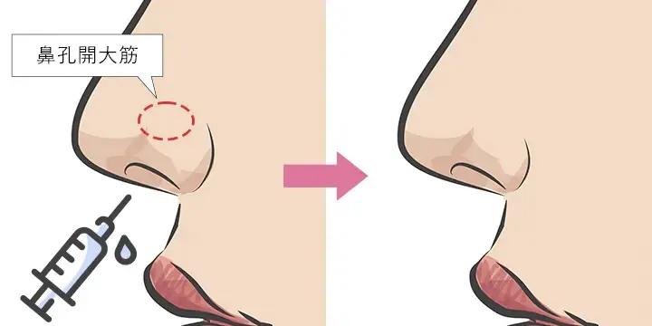 小鼻ボトックス注射の整形イメージ（湘南美容クリニックより引用）