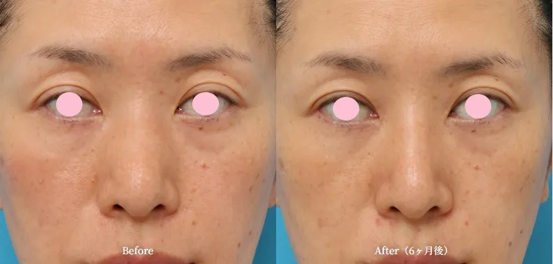 骨切り幅寄せによる鼻の整形例（高須クリニックHPより引用）