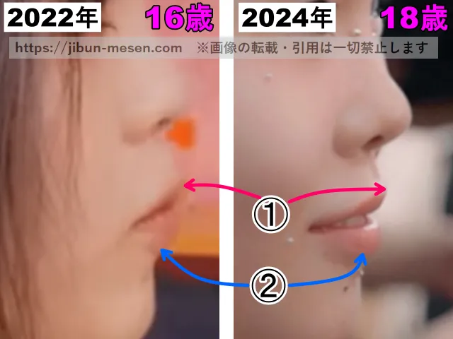 XGココナの口の整形検証2022年〜2024年（横顔・拡大）