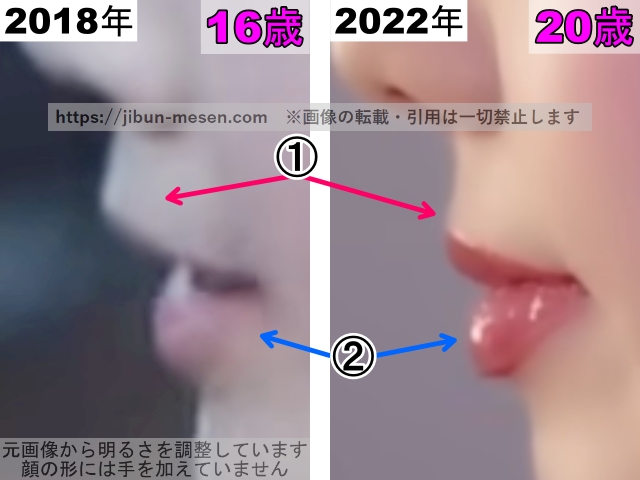 XGヒナタの唇の整形検証2018年〜2022年（横顔・拡大）の画像
