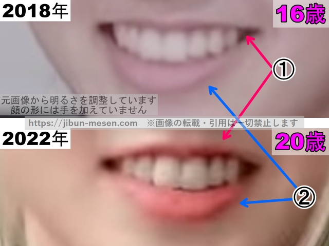 XGヒナタの唇の整形検証2018年～2022年（拡大）の画像