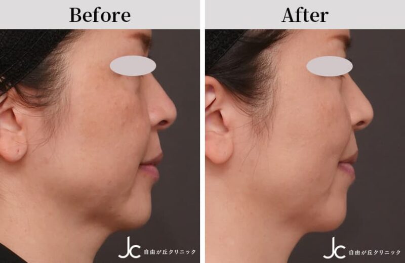 糸リフト（自由が丘クリニック-症例写真より引用）_1の画像