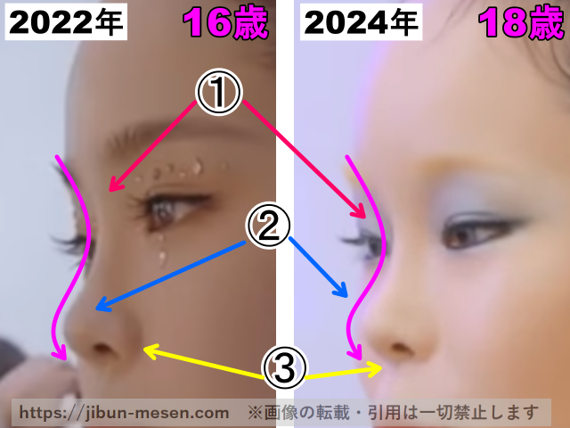 XGココナの鼻の整形検証2022年〜2024年（横顔・拡大）の画像