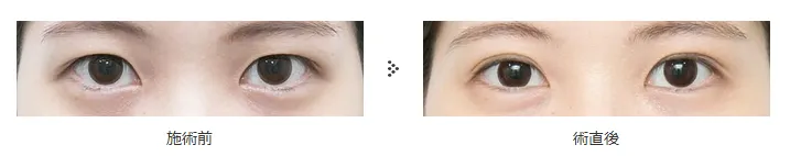 二重切開法による目の整形例（共立美容外科HPより引用）