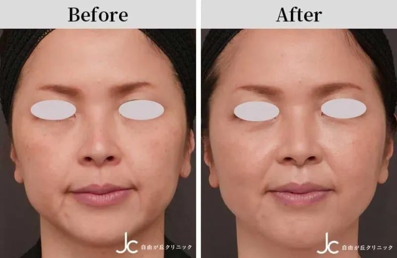 糸リフトによる頬の整形例_2（自由が丘クリニック-症例写真より引用）